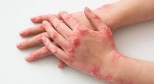 Psoriase (Foto/Reprodução)