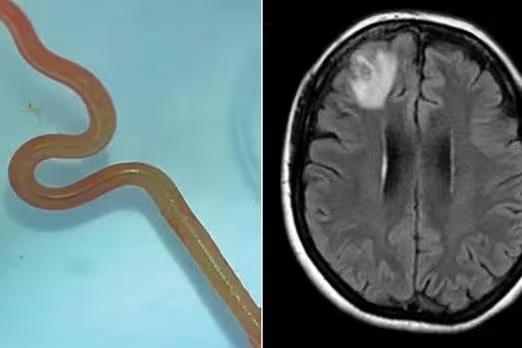 Um parasita de 8 centímetros, comum em cobras píton, foi encontrado pela primeira vez no cérebro de uma mulher de 64 anos (Foto/Reprodução)