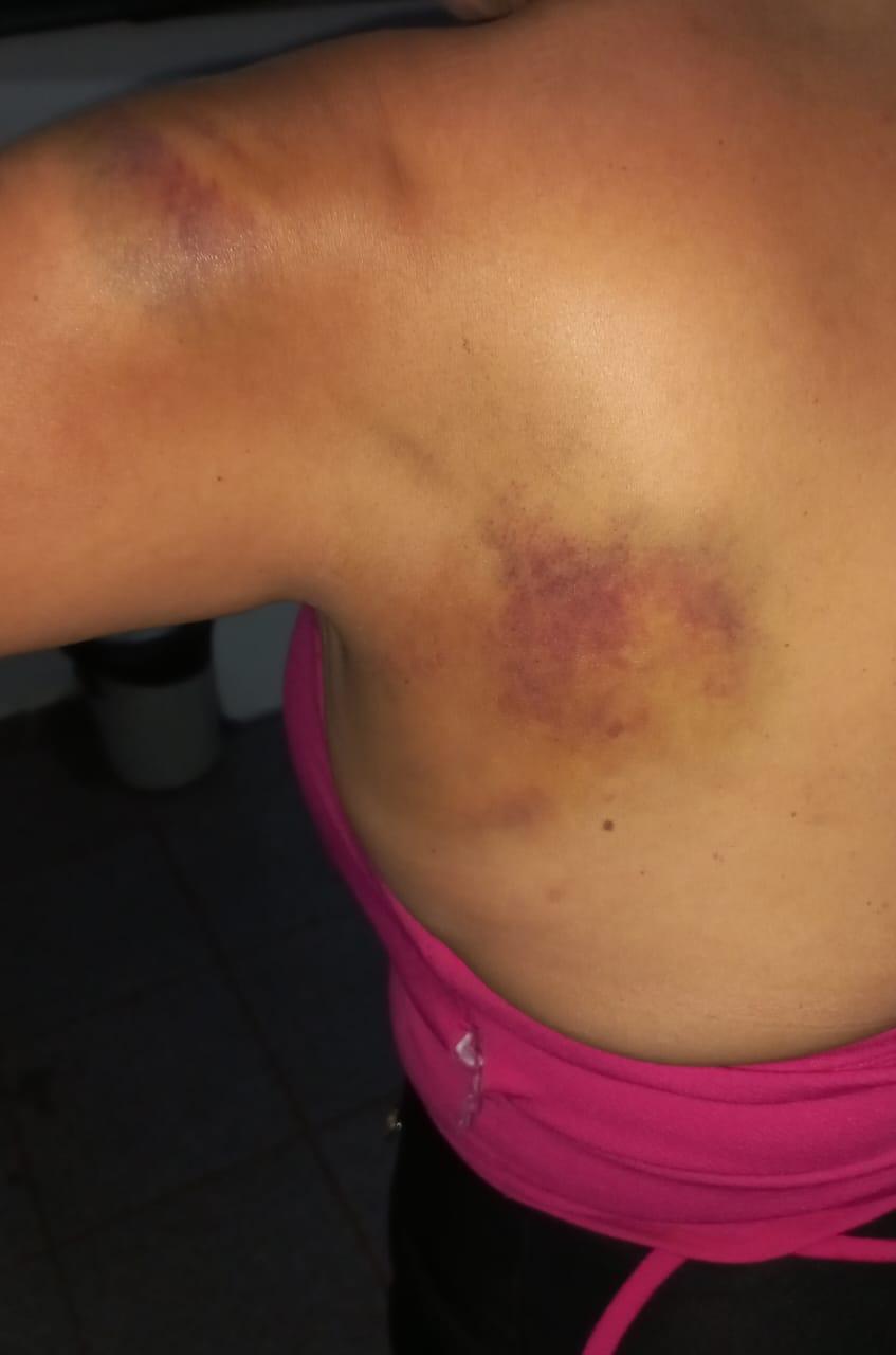 Hematomas no corpo da mulher vítima de agressão (Foto/Divulgação)