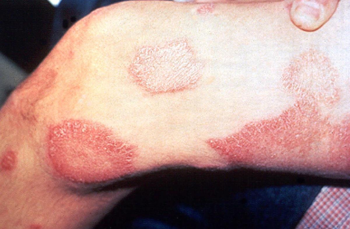 Um dos sintomas da hanseníase são as protuberâncias na pele (Foto/US.department of health and human services/Wikimedia Commons)