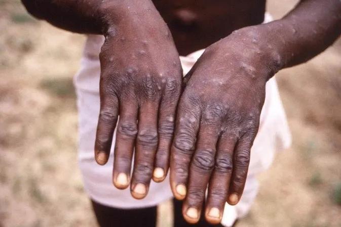 A decisão de convocar o comitê de emergência levou em conta o registro de casos fora da República Democrática do Congo, onde as infecções estão em ascensão há mais de dois anos (Foto/Reprodução)