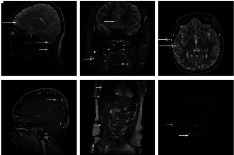 Ressonância magnética de mulher que ingeriu ovos de tênia para emagrecer mostra gravidade do caso (Foto/National Journal of Medicine)