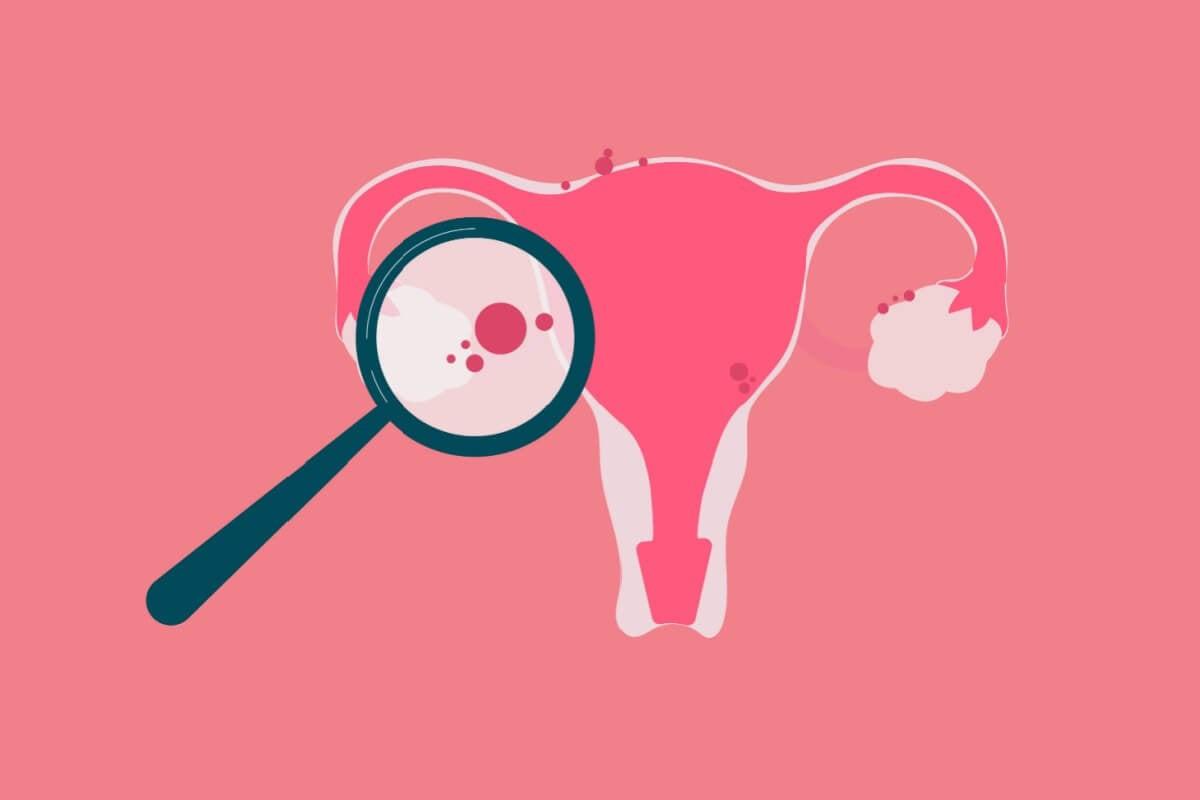 Com sintomas confundidos com outras condições, a endometriose exige acompanhamento especializado (Foto/Imagem/Gegambar/Shutterstock)