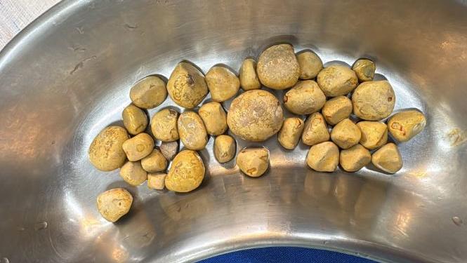 Em vídeo, o médico mostra uma bandeja cheia de pedras de grandes dimensões retiradas dos rins do paciente (Foto/Reprodução)