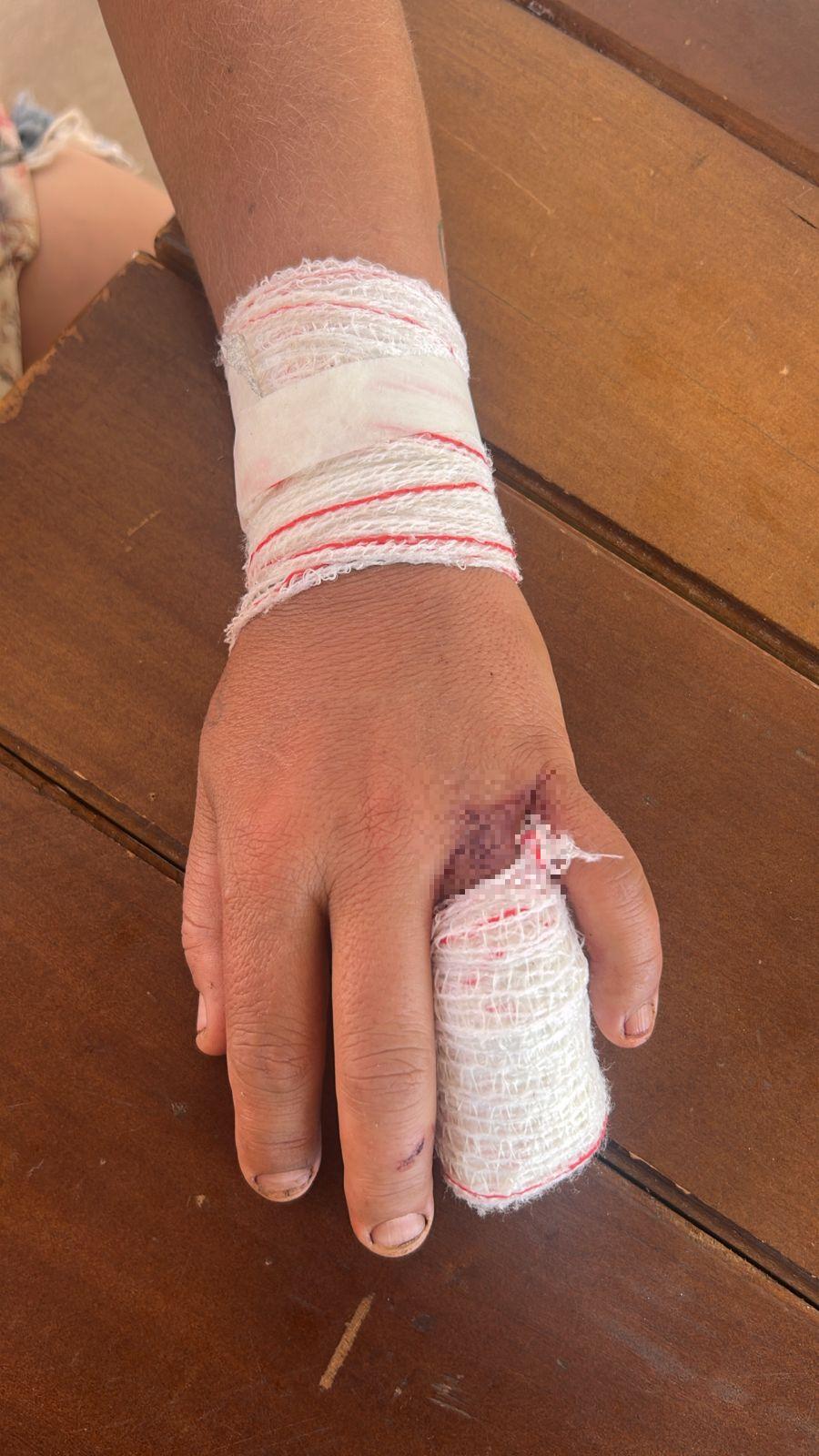 Vítima teve um dedo decepado devido às agressões (Foto/Divulgação GCM)