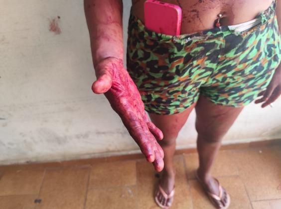 Mulher de 28 anos mostra uma das mãos ferida durante atendimento policial no motel do bairro Gameleiras (Foto/Divulgação)