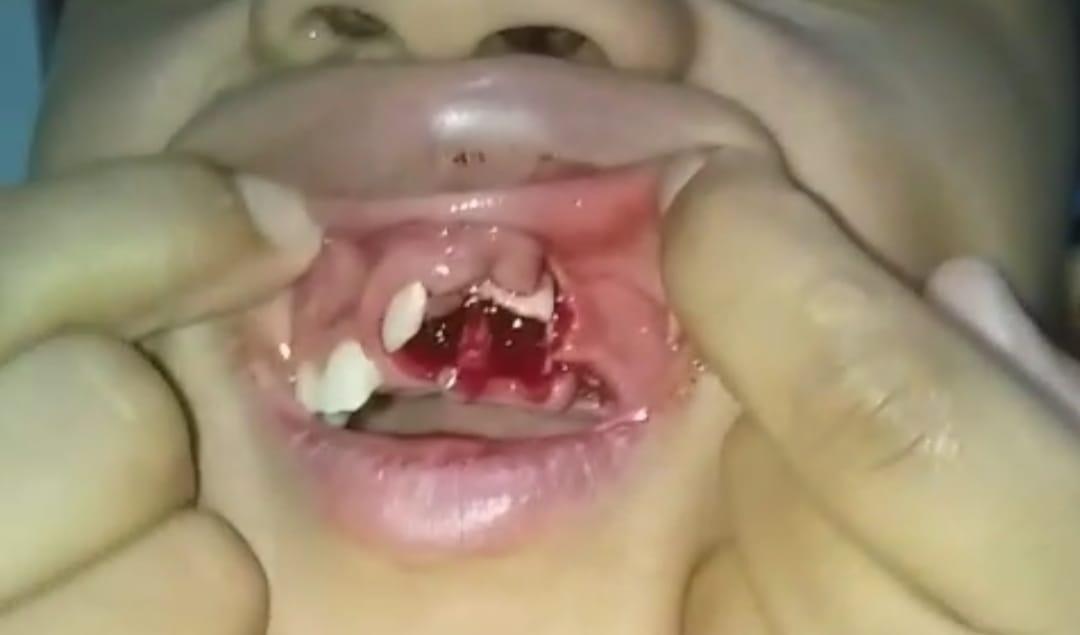 Estudante que caiu de boca no chão em escola está com fratura óssea (Foto/Divulgação)