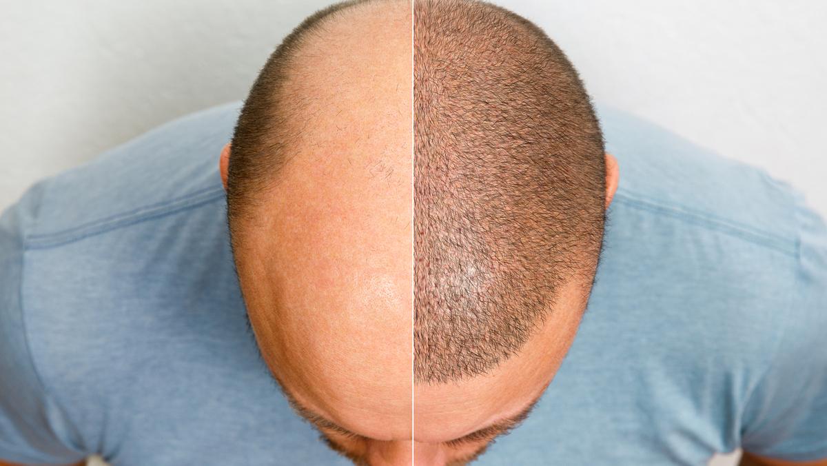 Os avanços recentes permitem que cada vez mais pacientes conquistem resultados naturais e expressivos, mesmo aqueles com calvície mais acentuada (Foto/Divulgação)