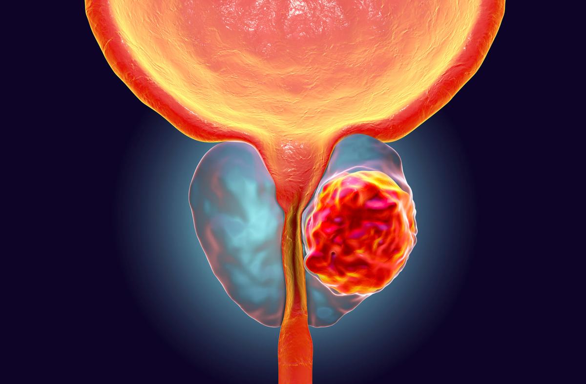 A decisão segue a recomendação da Comissão Nacional de Incorporação de Tecnologias no SUS (Conitec), que foi publicada em outubro de 2025 e passará a valer em 180 dias, prazo necessário para adaptação dos serviços e garantia de segurança assistencial (Foto/Reprodução)