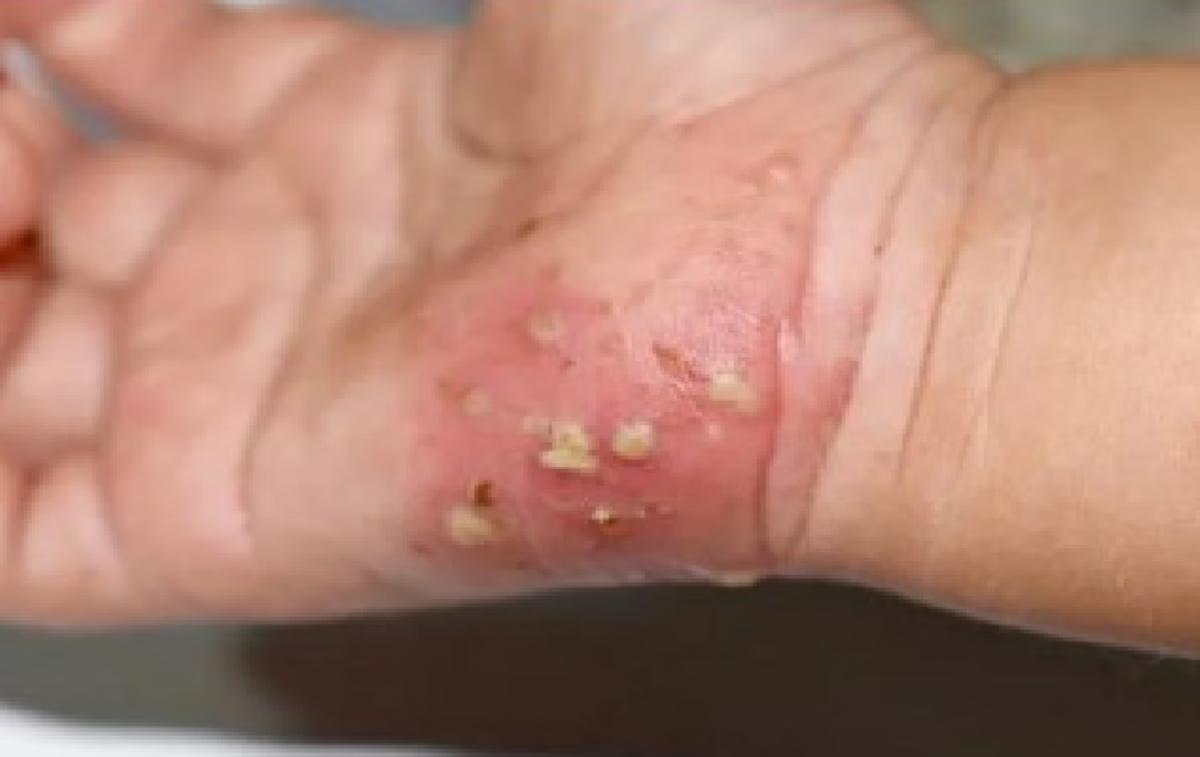 Sarna humana (escabiose) é transmitida principalmente por contato direto e prolongado pele a pele com uma pessoa infectada. (Foto/Secretaria de SP/Divulgação)