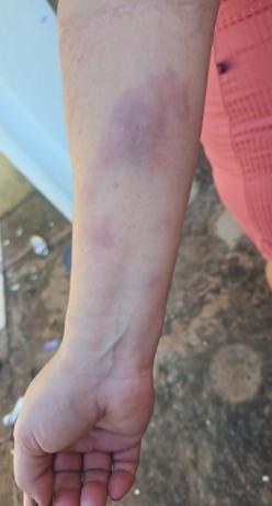 A mulher ficou com hematomas pelo braço, após agressões do ex-companheiro. (Foto/Divulgação/PMMG)