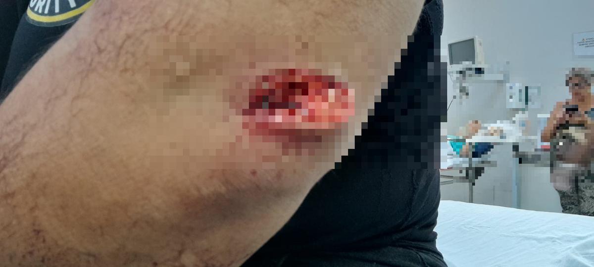 Corte no braço da jovem de 21 anos, provocado por golpe de canivete, durante discussão com motorista por aplicativo em um dos acessos do Praça Uberaba Shopping (Foto/Divulgação)
