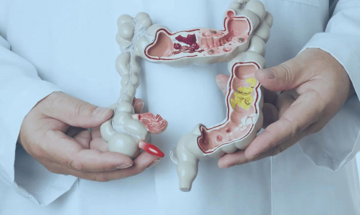 O tumor colorretal origina-se no intestino grosso, também chamado de cólon, e no reto, região final do trato digestivo e anterior ao ânus (Foto/iStockphoto/Divulgação)