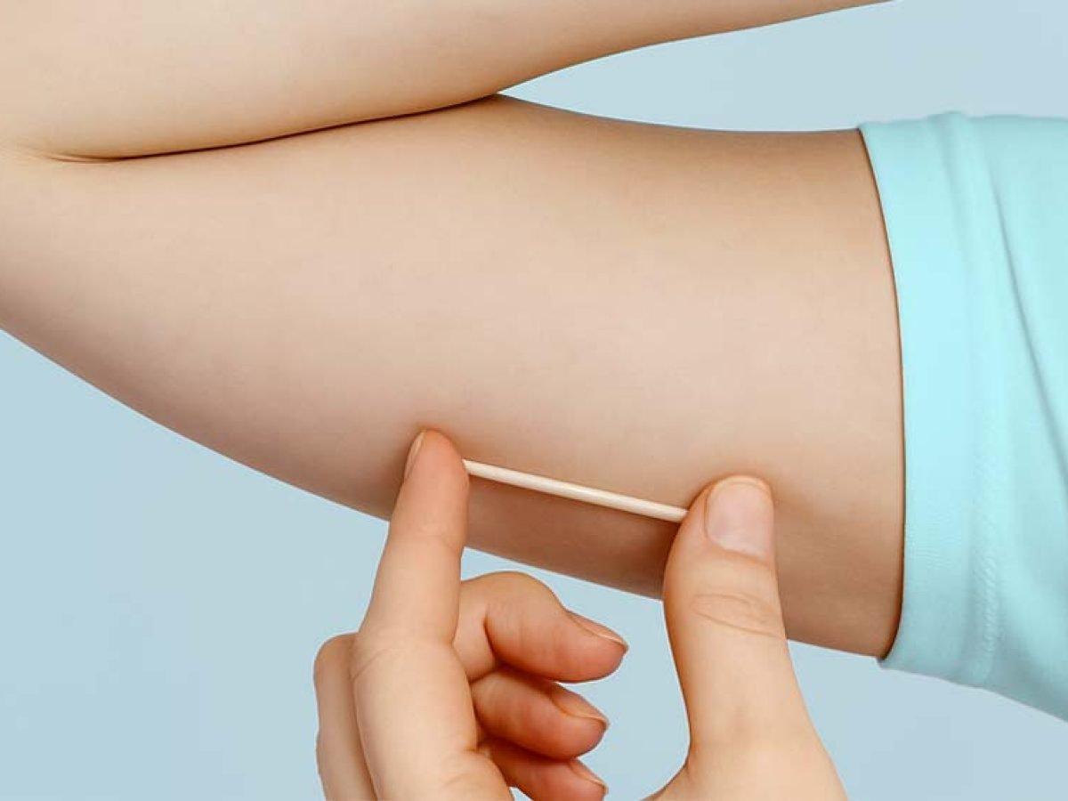 O contraceptivo implanon (Foto/Reprodução)