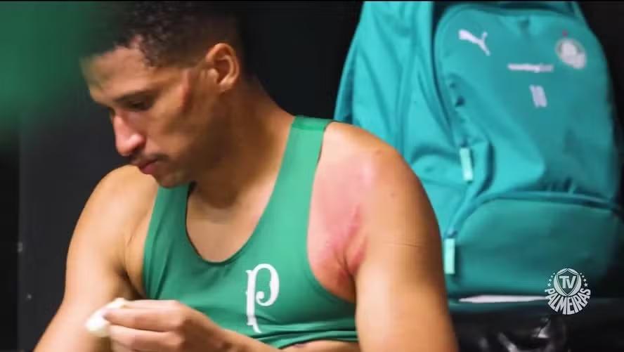 Murilo, do Palmeiras, com as marcas da solada de Carrascal no rosto e no ombro (Foto/Reprodução/TV Palmeiras)