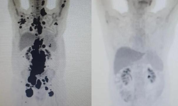 Exames mostram antes e depois de câncer de paciente; à direita, imagem mostra remissão da doença (Foto/Divulgação)