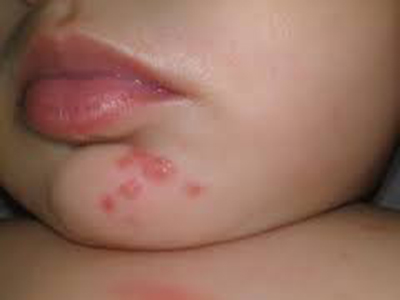 Bebe De 17 Dias Contrai Herpes Apos Beijo De Visita Jornal Da Manha 49 Anos